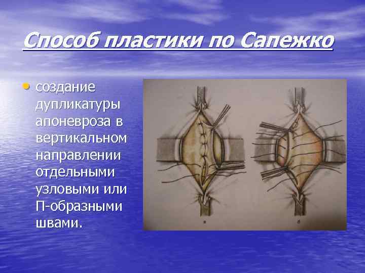 Пластика по сапежко