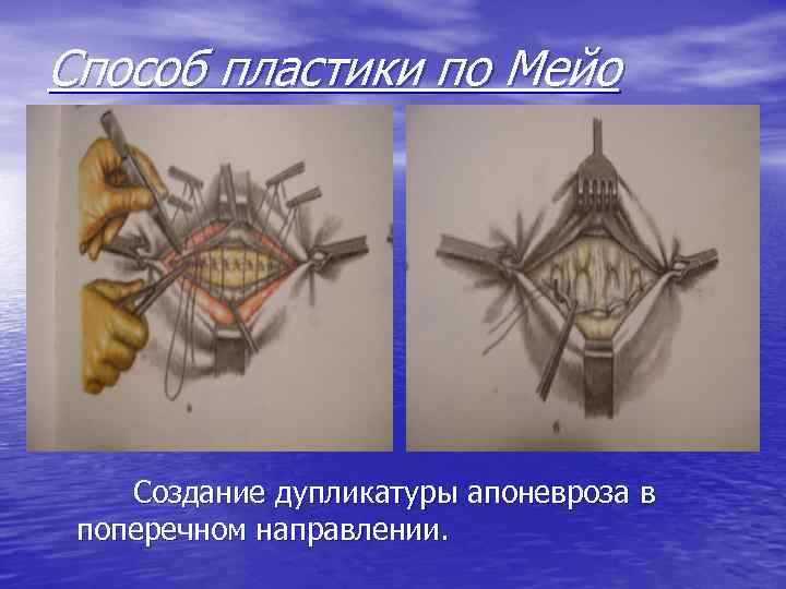 Способ пластики по Мейо Создание дупликатуры апоневроза в поперечном направлении. 