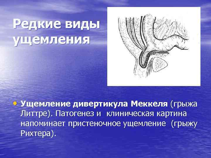 Грыжи факультетская хирургия презентация