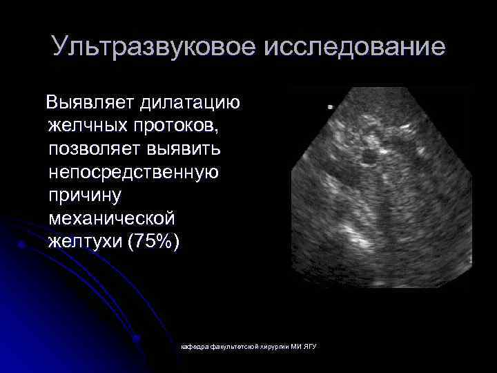 Ультразвуковое исследование Выявляет дилатацию желчных протоков, позволяет выявить непосредственную причину механической желтухи (75%) кафедра