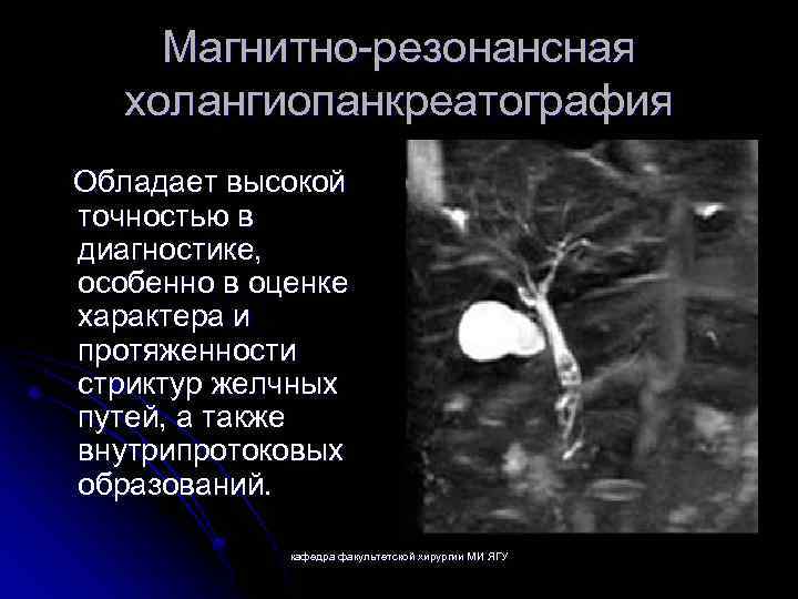 Магнитно резонансная холангиопанкреатография Обладает высокой точностью в диагностике, особенно в оценке характера и протяженности