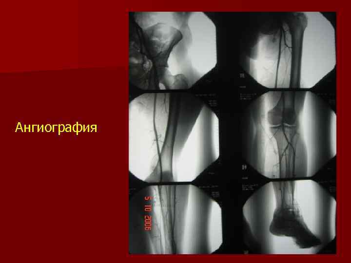 Ангиография 