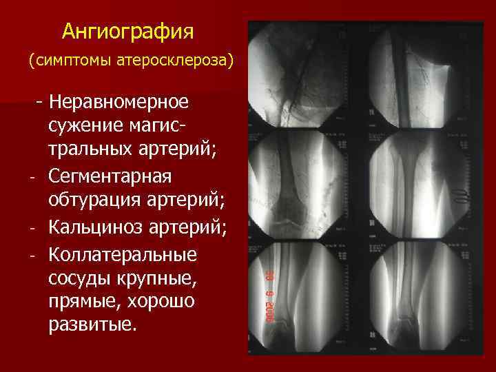 Ангиография (симптомы атеросклероза) - Неравномерное сужение магистральных артерий; - Сегментарная обтурация артерий; - Кальциноз
