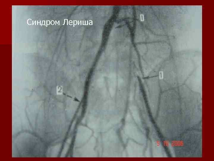 Синдром Лериша 