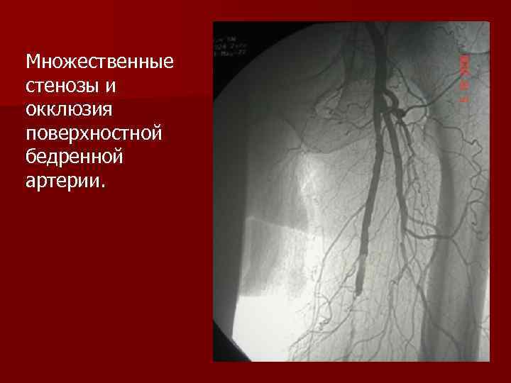 Множественные стенозы и окклюзия поверхностной бедренной артерии. 