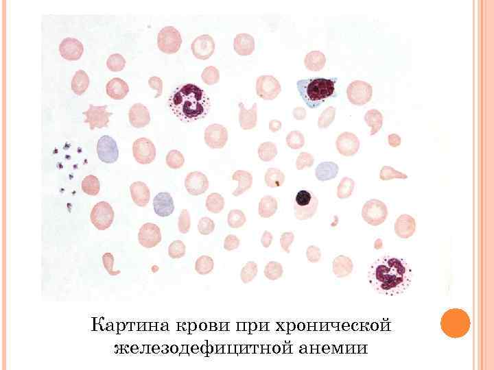 Картина периферической крови при железодефицитной анемии