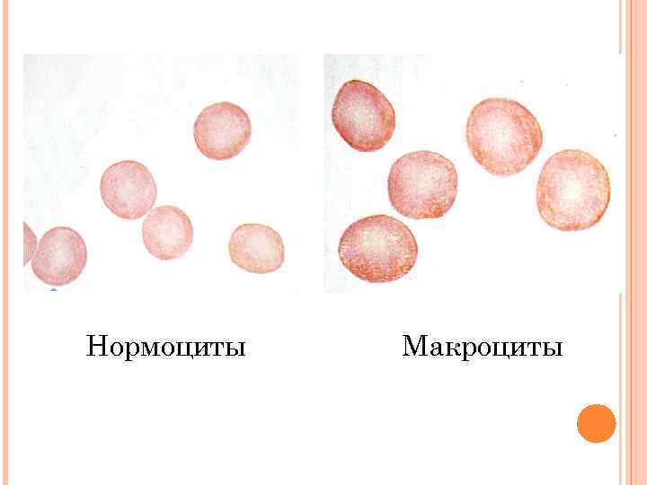 Макроциты. Анизоцитоз нормоциты микроциты макроциты. Макроциты анемия. Микроцитоз макроцитоз эритроцитов. Эритроциты нормоциты.