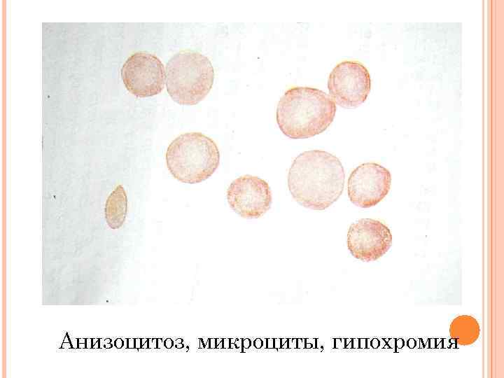 Анизоцитоз, микроциты, гипохромия 