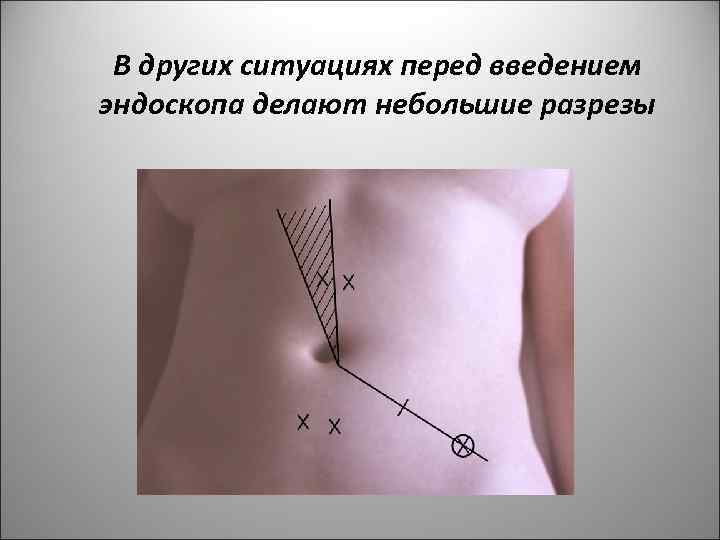 В других ситуациях перед введением эндоскопа делают небольшие разрезы 