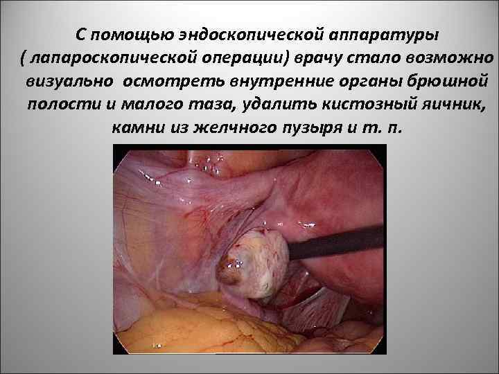 С помощью эндоскопической аппаратуры ( лапароскопической операции) врачу стало возможно визуально осмотреть внутренние органы