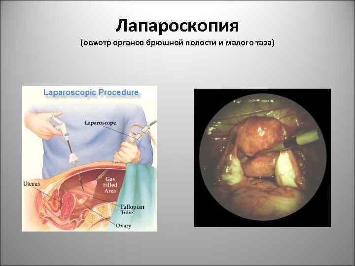 Лапароскопия (осмотр органов брюшной полости и малого таза) 