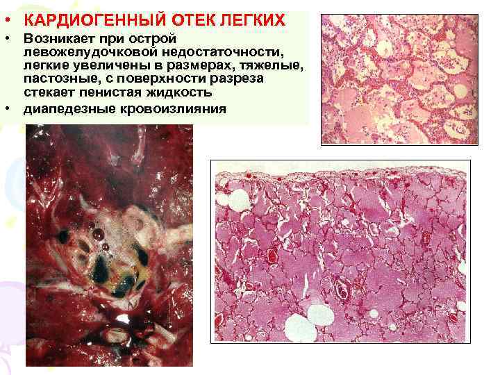  • КАРДИОГЕННЫЙ ОТЕК ЛЕГКИХ • Возникает при острой левожелудочковой недостаточности, легкие увеличены в