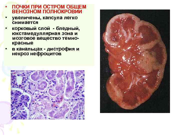  • ПОЧКИ ПРИ ОСТРОМ ОБЩЕМ ВЕНОЗНОМ ПОЛНОКРОВИИ • увеличены, капсула легко снимается •
