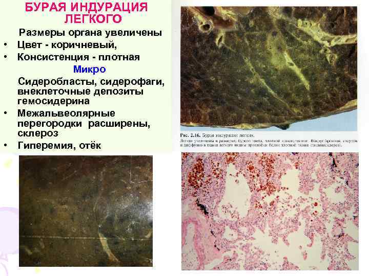 БУРАЯ ИНДУРАЦИЯ ЛЕГКОГО • • Размеры органа увеличены Цвет - коричневый, Консистенция - плотная