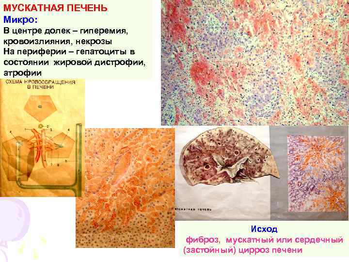 МУСКАТНАЯ ПЕЧЕНЬ Микро: В центре долек – гиперемия, кровоизлияния, некрозы На периферии – гепатоциты