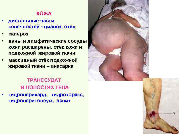 • • КОЖА дистальные части конечностей - цианоз, отек склероз вены и лимфатические