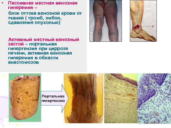  • Пассивная местная венозная гиперемия – блок оттока венозной крови от тканей (