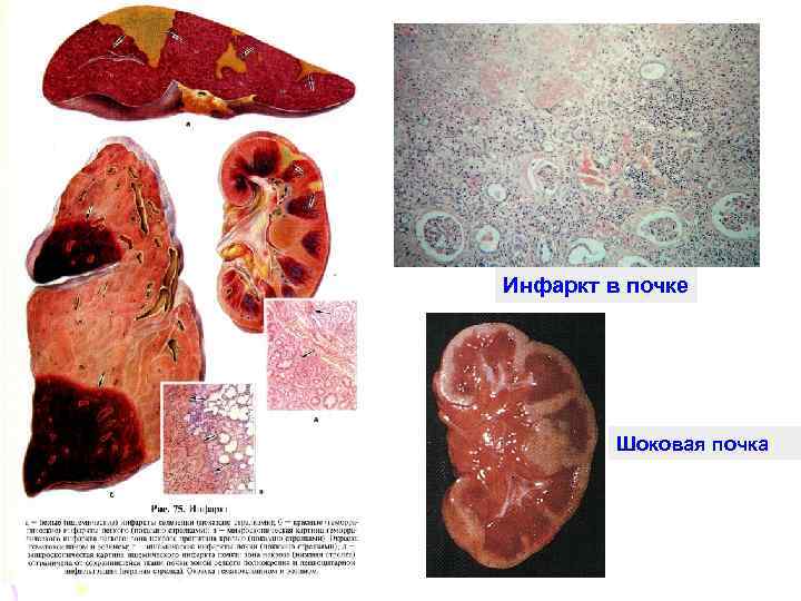 Инфаркт в почке Шоковая почка 