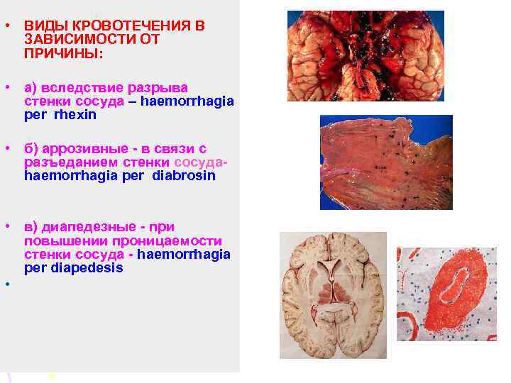  • ВИДЫ КРОВОТЕЧЕНИЯ В ЗАВИСИМОСТИ ОТ ПРИЧИНЫ: • а) вследствие разрыва стенки сосуда