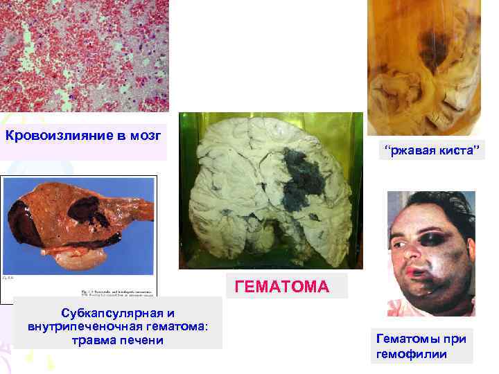 Кровоизлияние в мозг “ржавая киста” ГЕМАТОМА Субкапсулярная и внутрипеченочная гематома: травма печени Гематомы при