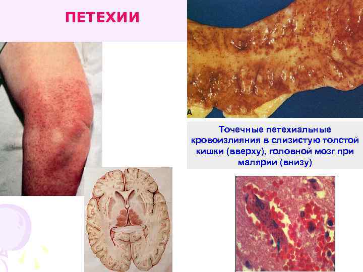 ПЕТЕХИИ Точечные петехиальные кровоизлияния в слизистую толстой кишки (вверху), головной мозг при малярии (внизу)