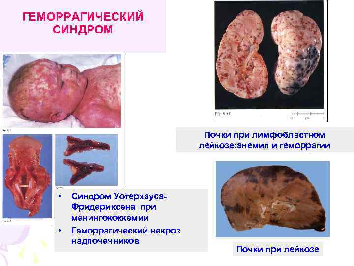 ГЕМОРРАГИЧЕСКИЙ СИНДРОМ Почки при лимфобластном лейкозе: анемия и геморрагии • • Синдром Уотерхауса. Фридериксена