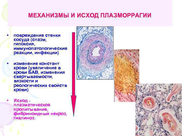 МЕХАНИЗМЫ И ИСХОД ПЛАЗМОРРАГИИ • повреждение стенки сосуда (спазм, гипоксия, иммунопатологические реакции, инфекции) •
