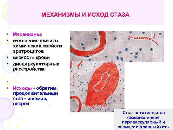 МЕХАНИЗМЫ И ИСХОД СТАЗА • Механизмы: • изменение физикохимических свойств эритроцитов • вязкость крови