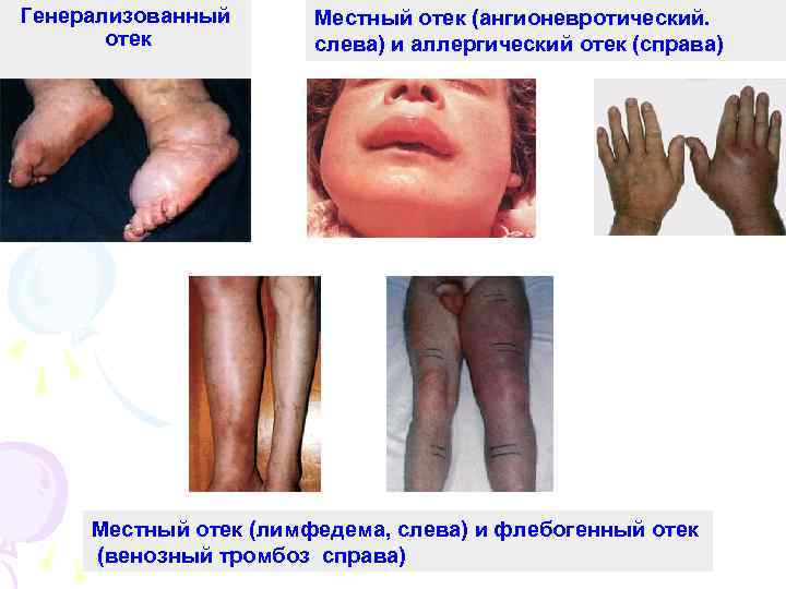 Генерализованный отек Местный отек (ангионевротический. слева) и аллергический отек (справа) Местный отек (лимфедема, слева)