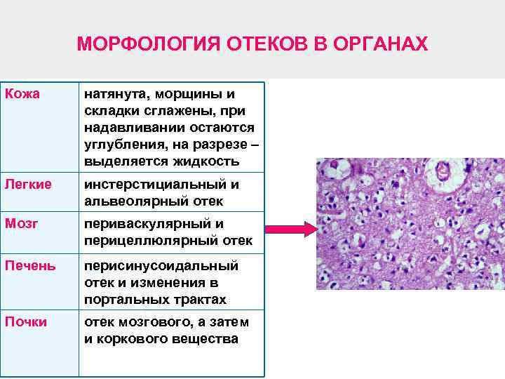 МОРФОЛОГИЯ ОТЕКОВ В ОРГАНАХ Кожа натянута, морщины и складки сглажены, при надавливании остаются углубления,