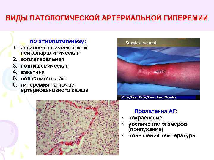 ВИДЫ ПАТОЛОГИЧЕСКОЙ АРТЕРИАЛЬНОЙ ГИПЕРЕМИИ по этиопатогенезу: 1. ангионевротическая или нейропаралитическая 2. коллатеральная 3. постишемическая