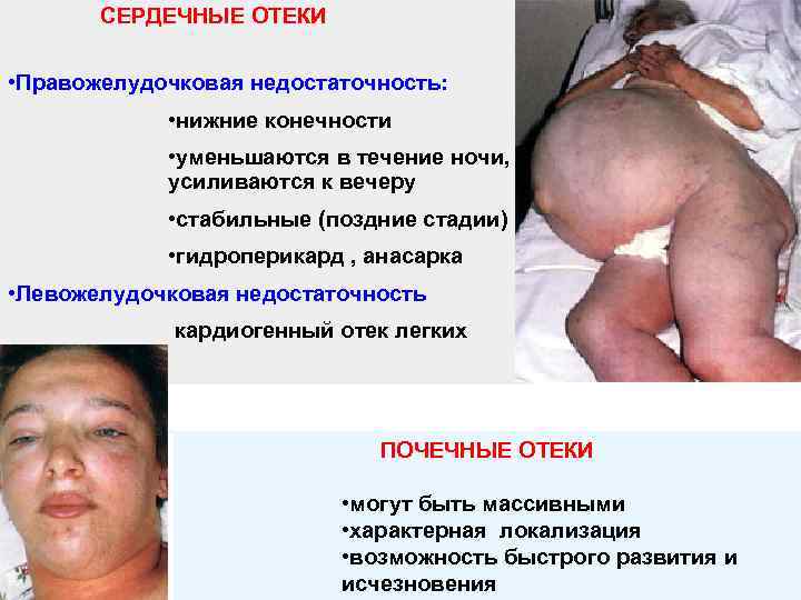 СЕРДЕЧНЫЕ ОТЕКИ • Правожелудочковая недостаточность: • нижние конечности • уменьшаются в течение ночи, усиливаются