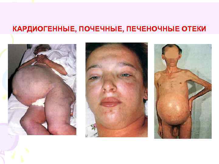 КАРДИОГЕННЫЕ, ПОЧЕЧНЫЕ, ПЕЧЕНОЧНЫЕ ОТЕКИ 