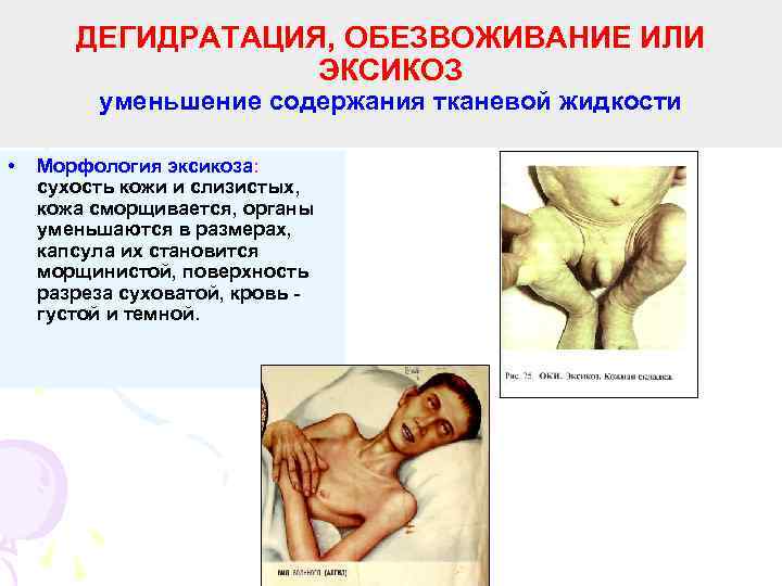 ДЕГИДРАТАЦИЯ, ОБЕЗВОЖИВАНИЕ ИЛИ ЭКСИКОЗ уменьшение содержания тканевой жидкости • Морфология эксикоза: сухость кожи и