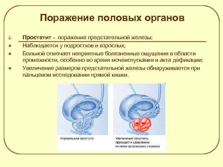 Поражение половых органов 2. l l l Простатит - поражение предстательной железы; Наблюдается у