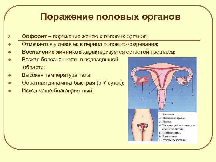 Поражение половых органов 3. l l l Оофорит – поражение женских половых органов; Отмечается