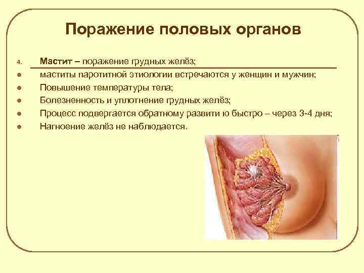 Поражение половых органов 4. l l l Мастит – поражение грудных желёз; маститы паротитной