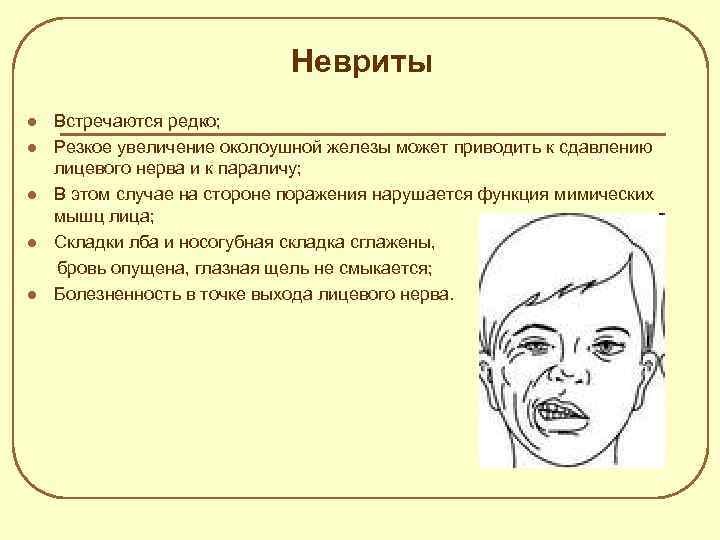 Невриты l l l Встречаются редко; Резкое увеличение околоушной железы может приводить к сдавлению