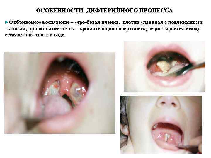 ОСОБЕННОСТИ ДИФТЕРИЙНОГО ПРОЦЕССА ►Фибринозное воспаление – серо-белая пленка, плотно спаянная с подлежащими тканями, при