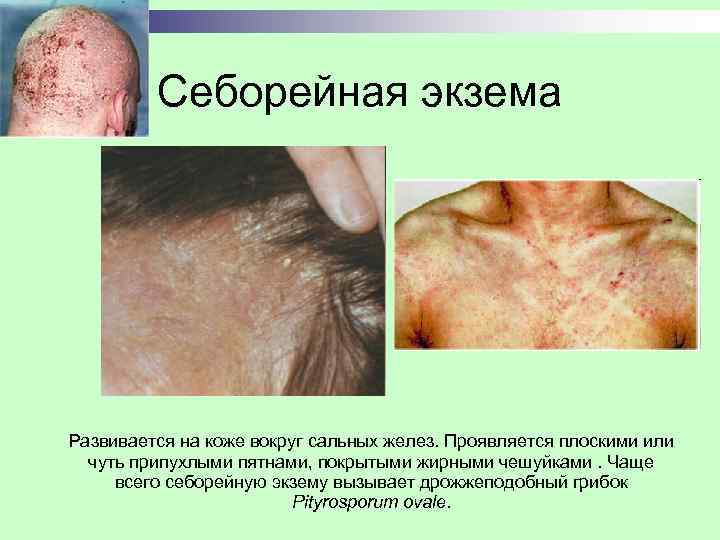 Себорейная экзема Развивается на коже вокруг сальных желез. Проявляется плоскими или чуть припухлыми пятнами,