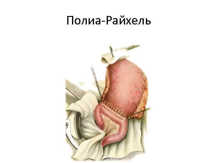 Полиа-Райхель 