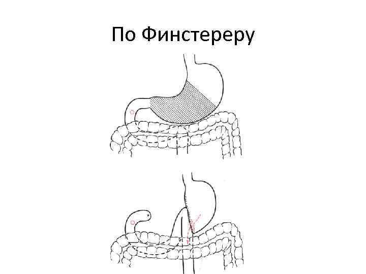 После операции на желудке. Операция по гофмейстеру Финстереру. Резекция желудка по гофмейстеру-Финстереру схема. Анастомоз по Финстереру.