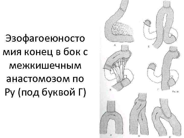 Анастомоз по брауну схема