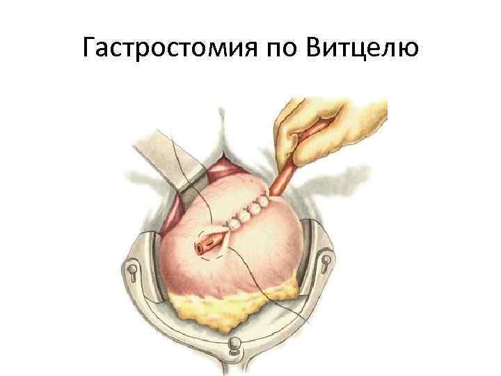 Гастростомия по Витцелю 