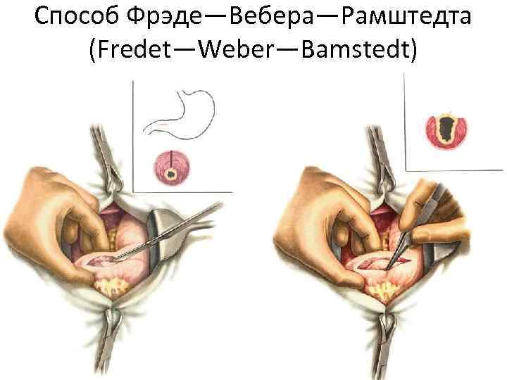 Способ Фрэде—Вебера—Рамштедта (Fredet—Weber—Bamstedt) 