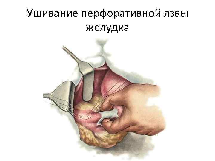 Ушивание перфоративной язвы желудка 