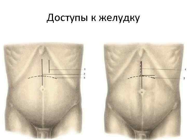 Доступы к желудку 