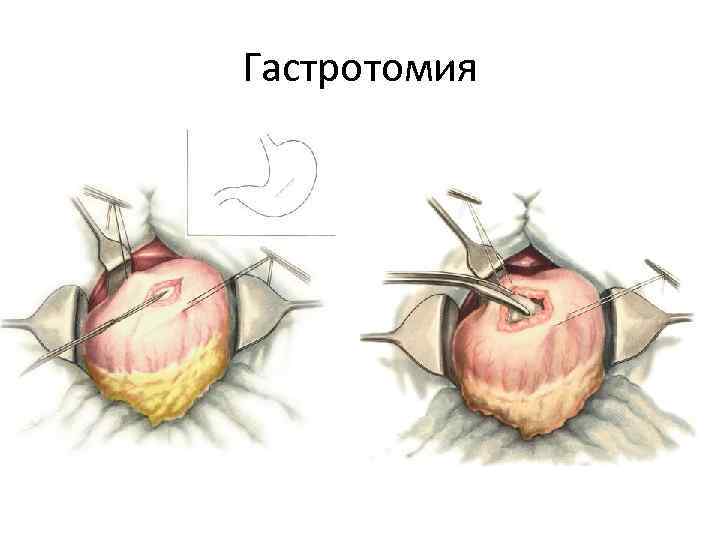 Гастрошунтирование желудка фото