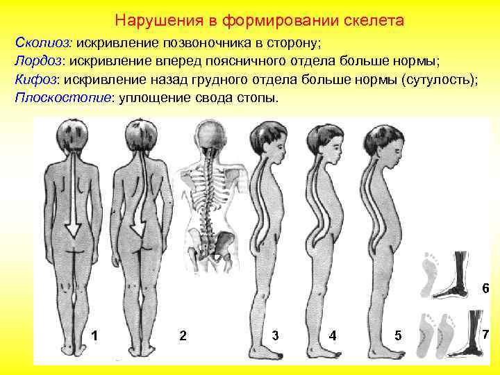 Нарушения в формировании скелета Сколиоз: искривление позвоночника в сторону; Лордоз: искривление вперед поясничного отдела