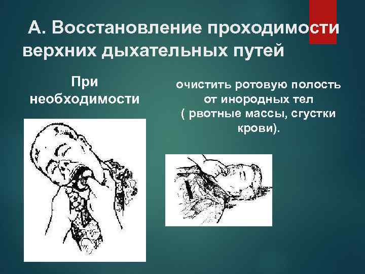 А. Восстановление проходимости верхних дыхательных путей При необходимости очистить ротовую полость от инородных тел